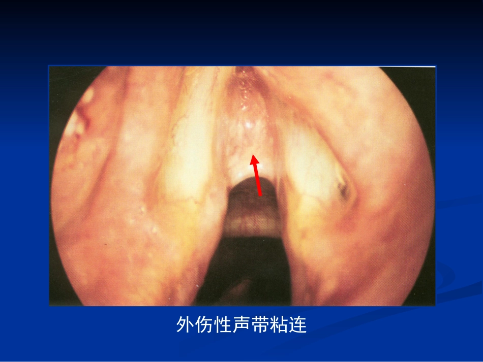 间接喉镜检查_第6页