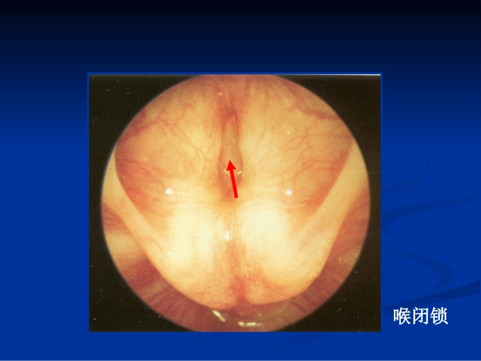 间接喉镜检查_第7页