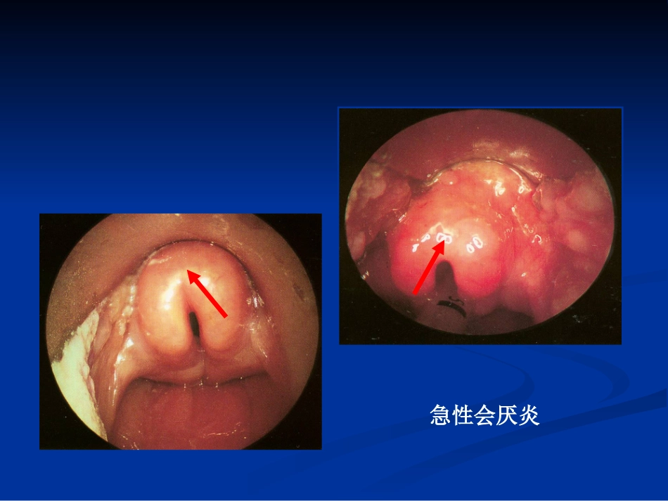 间接喉镜检查_第8页