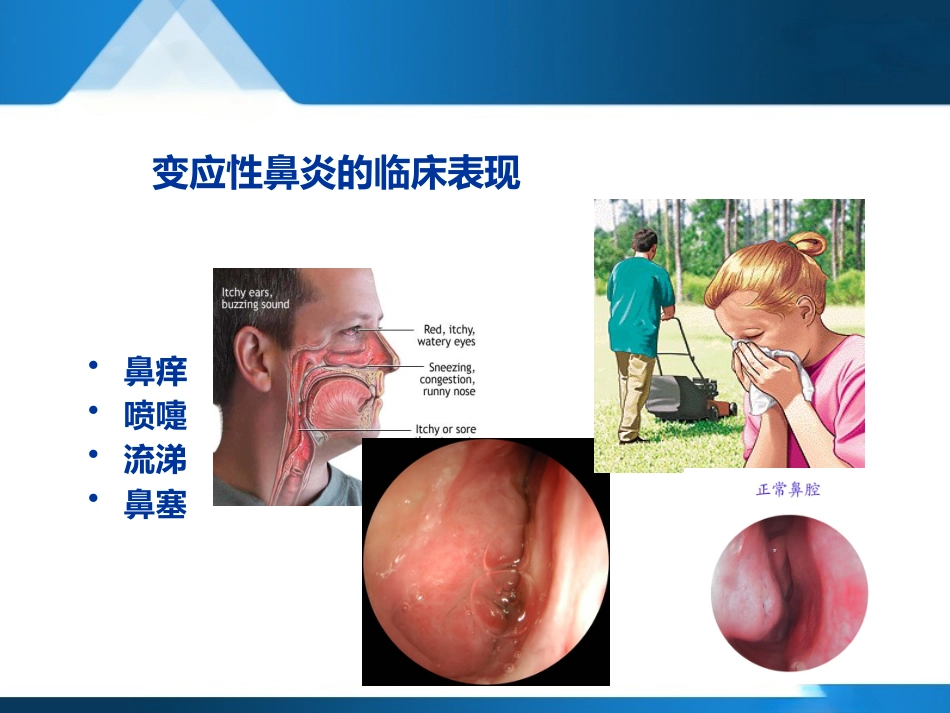 变应性鼻炎聚焦超声治疗--forsale_第11页