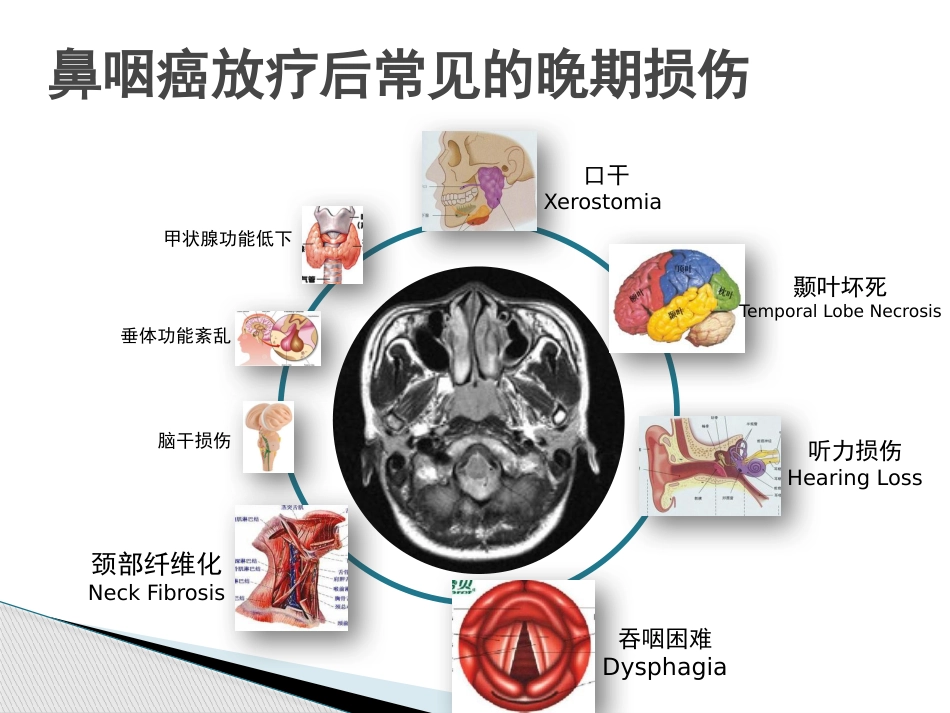 鼻咽癌调强放射治疗后晚期放射性损伤_第11页