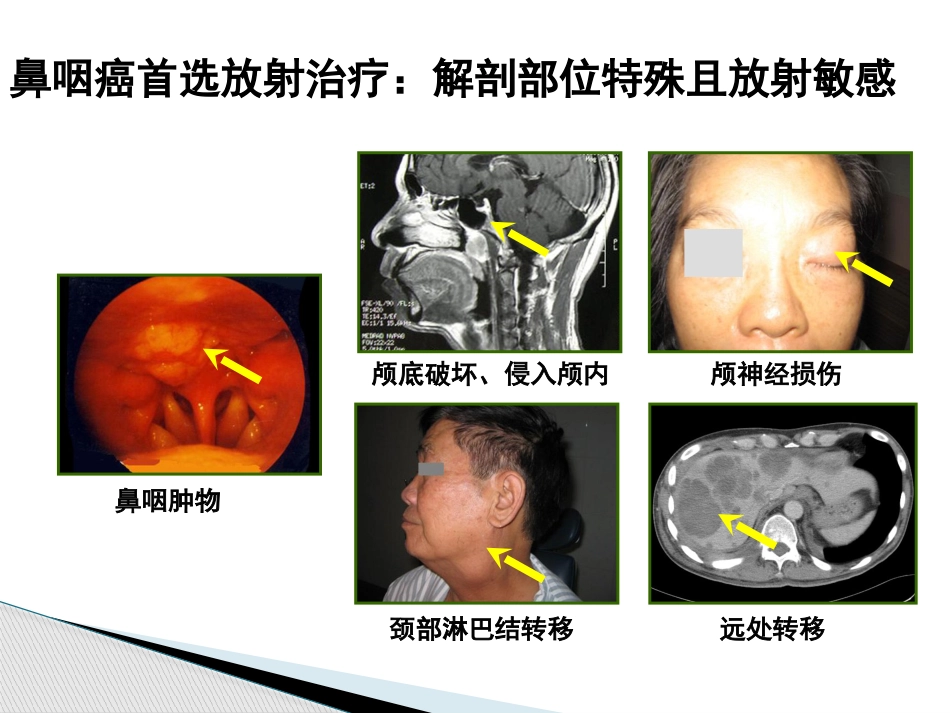 鼻咽癌调强放射治疗后晚期放射性损伤_第3页