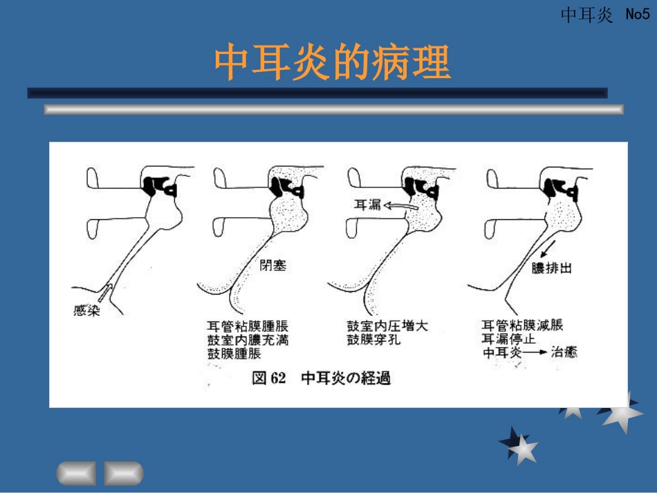 急性化脓性中耳炎_第5页