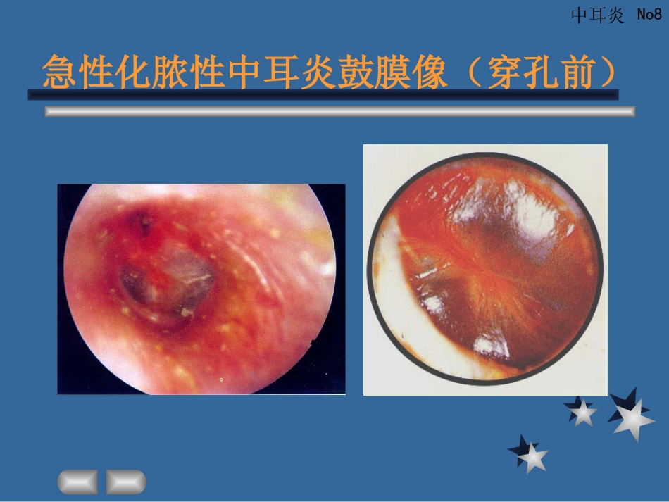 急性化脓性中耳炎_第8页