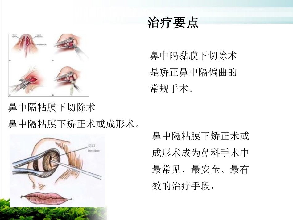 鼻中隔偏曲矫正术张影_第14页