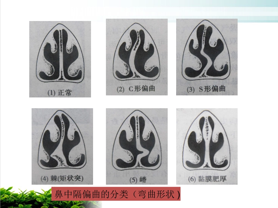 鼻中隔偏曲矫正术张影_第7页