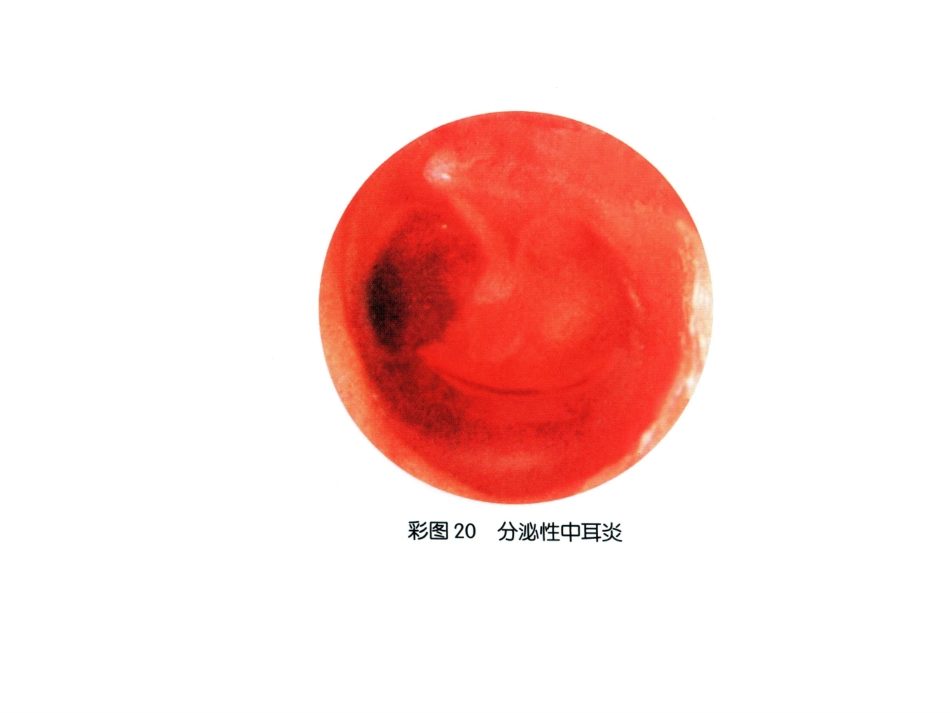 分泌性中耳炎ppt_第10页