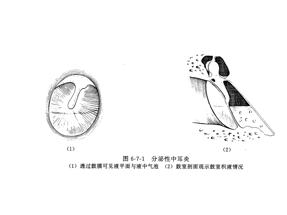 分泌性中耳炎ppt_第11页