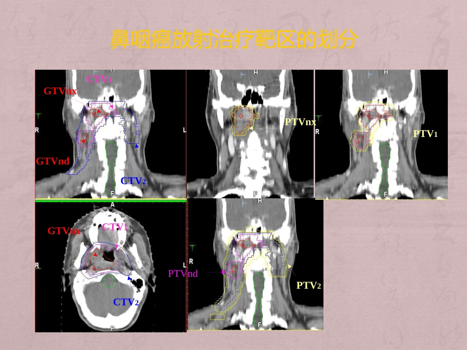 鼻咽癌靶区勾画与剂量处方_第11页