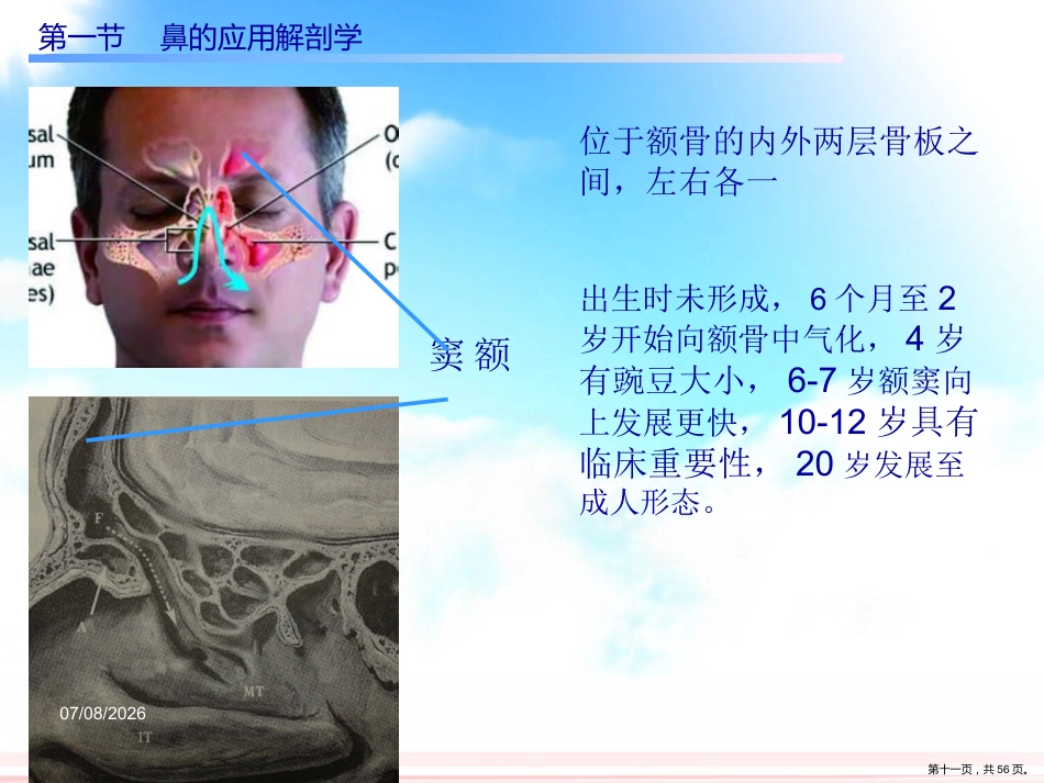 慢性鼻窦炎课件_第11页