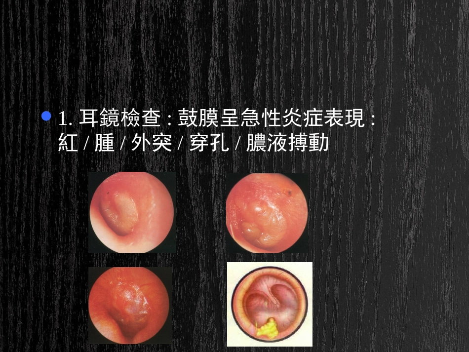 急慢性化脓性中耳炎及并发症PPT_第7页