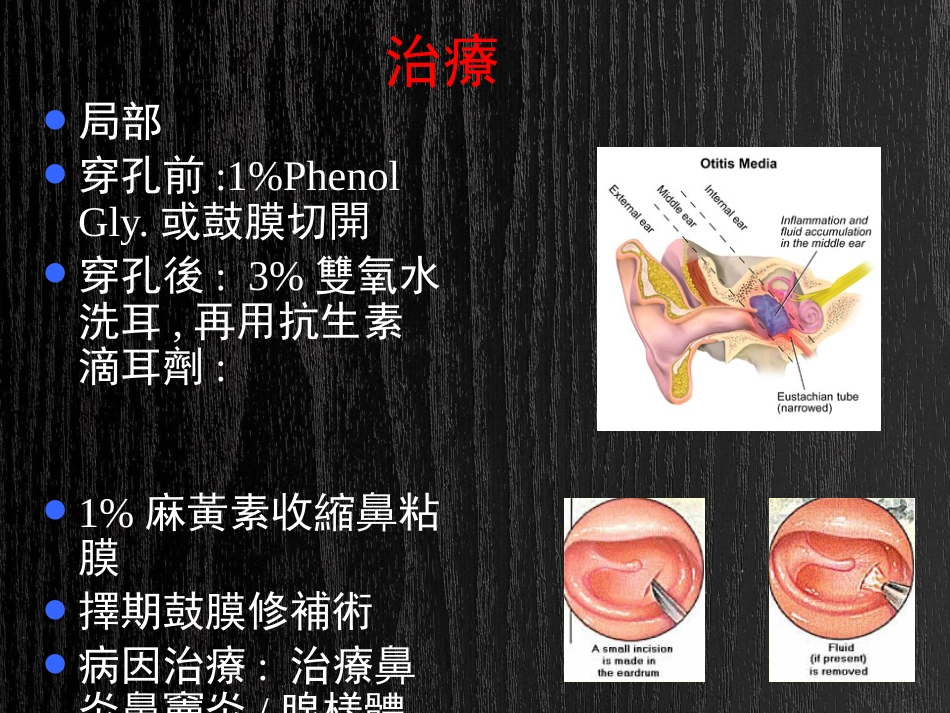 急慢性化脓性中耳炎及并发症PPT_第9页