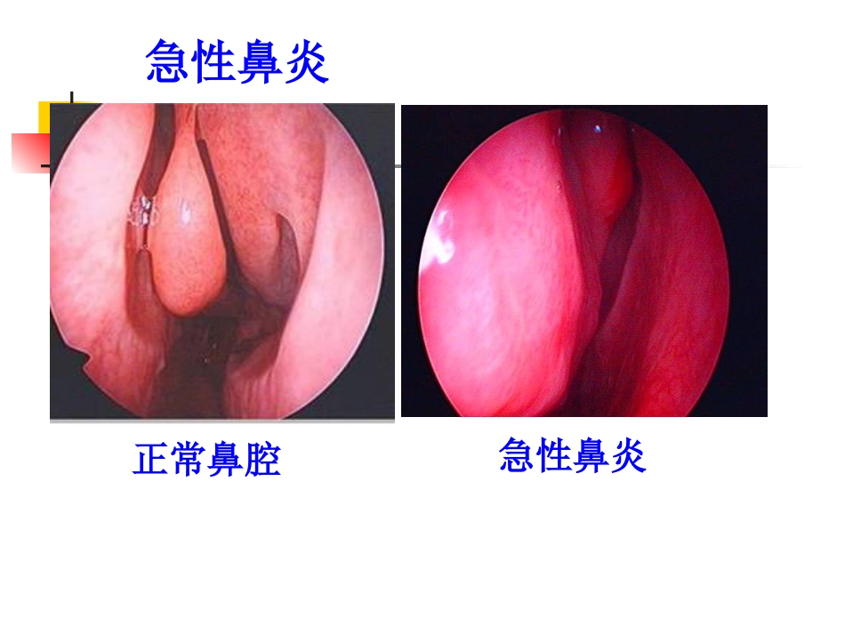 鼻部疾病_第11页