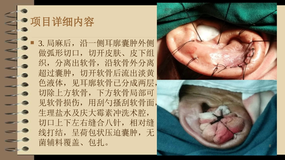 耳廓假性囊肿治疗新技术_第8页