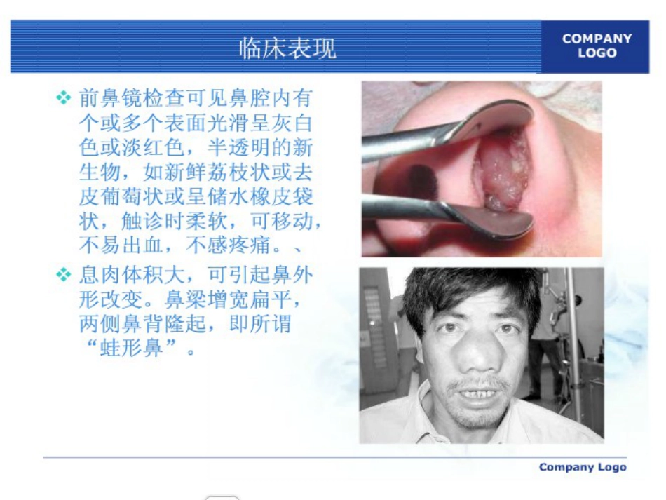鼻息肉护理ppt课件_第8页