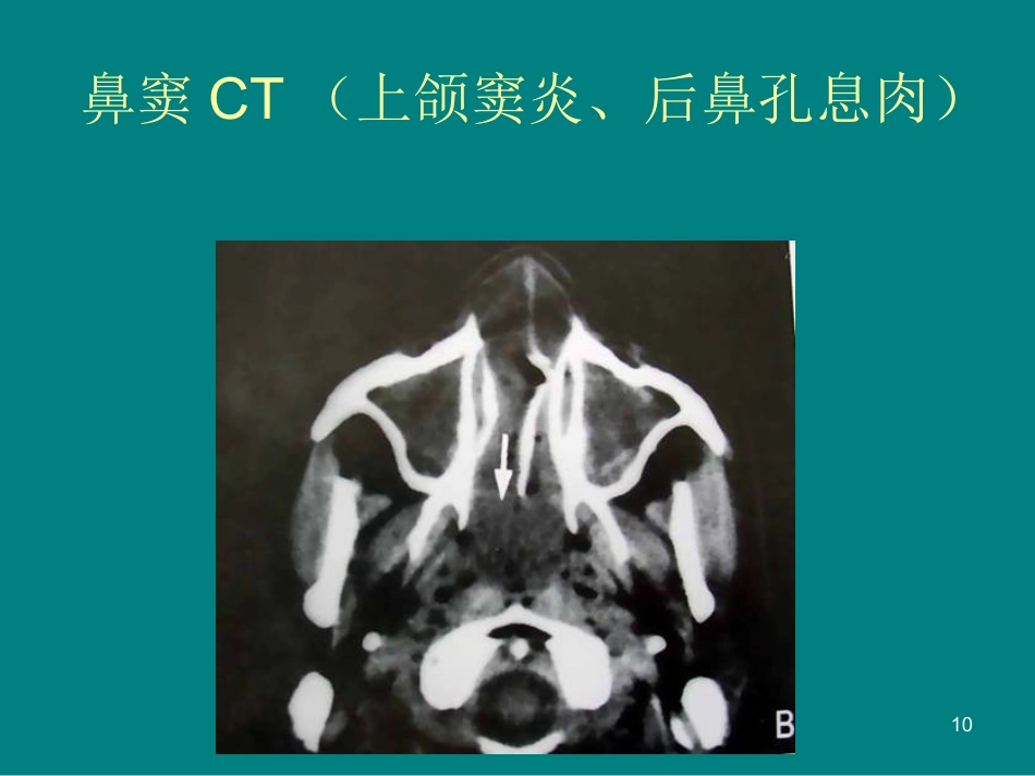 儿童鼻窦炎诊断和治疗建议ppt课件_第10页
