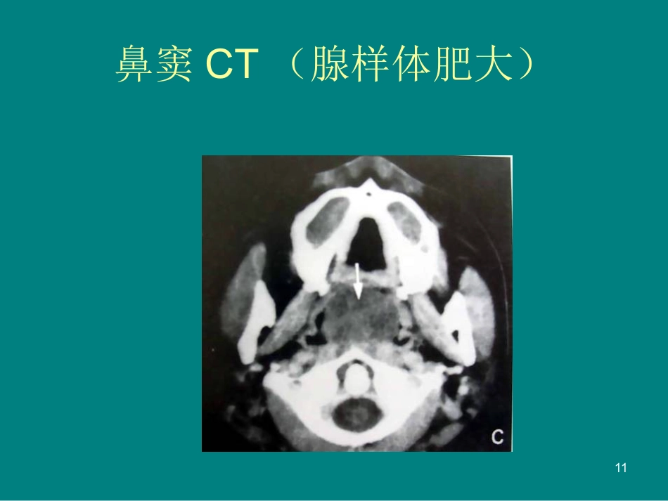 儿童鼻窦炎诊断和治疗建议ppt课件_第11页