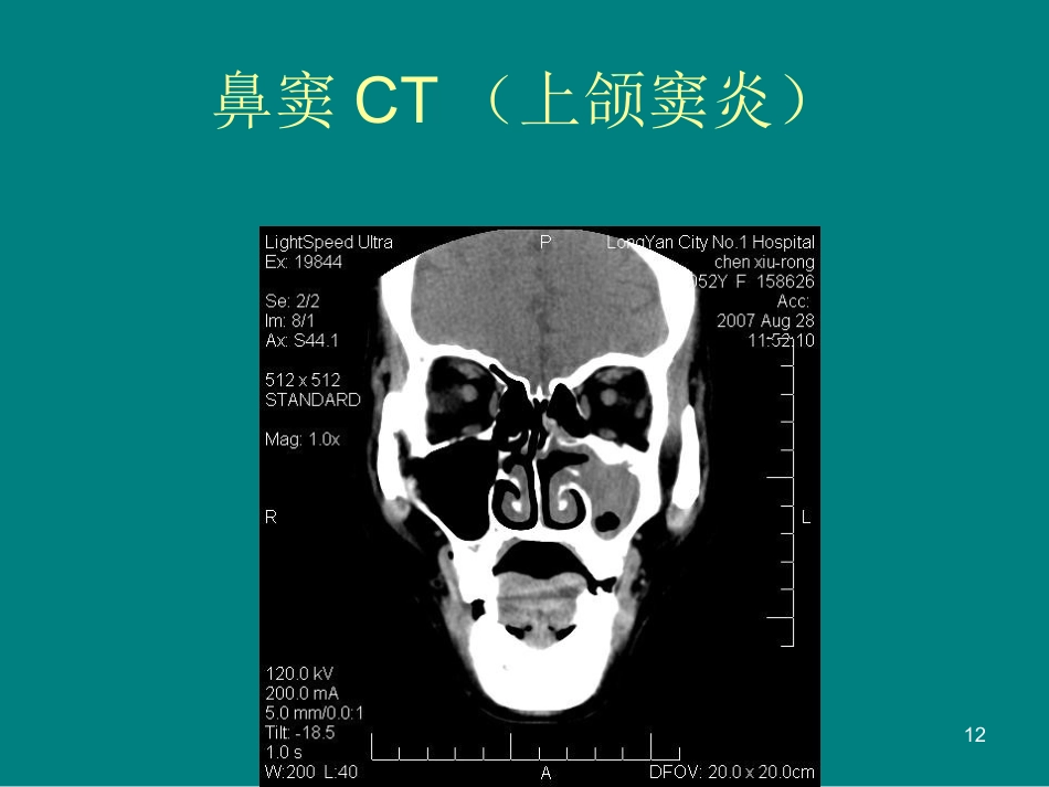 儿童鼻窦炎诊断和治疗建议ppt课件_第12页