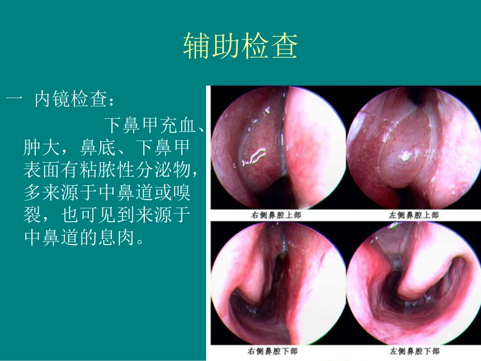 儿童鼻窦炎诊断和治疗建议ppt课件_第8页