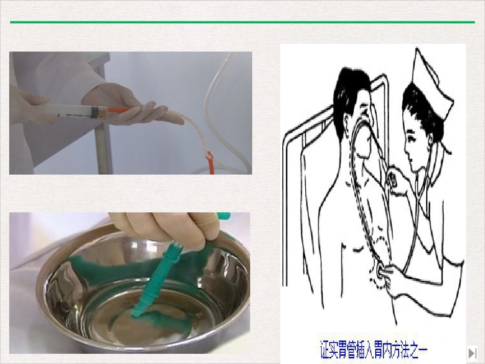 留置鼻胃管鼻饲PPT_第11页