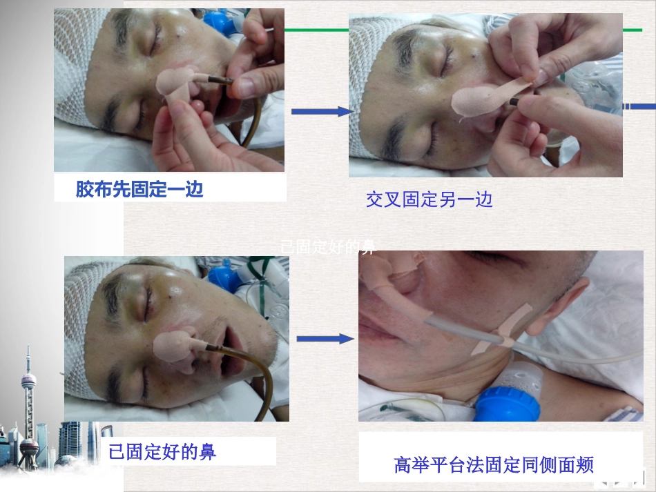 留置鼻胃管鼻饲PPT_第15页