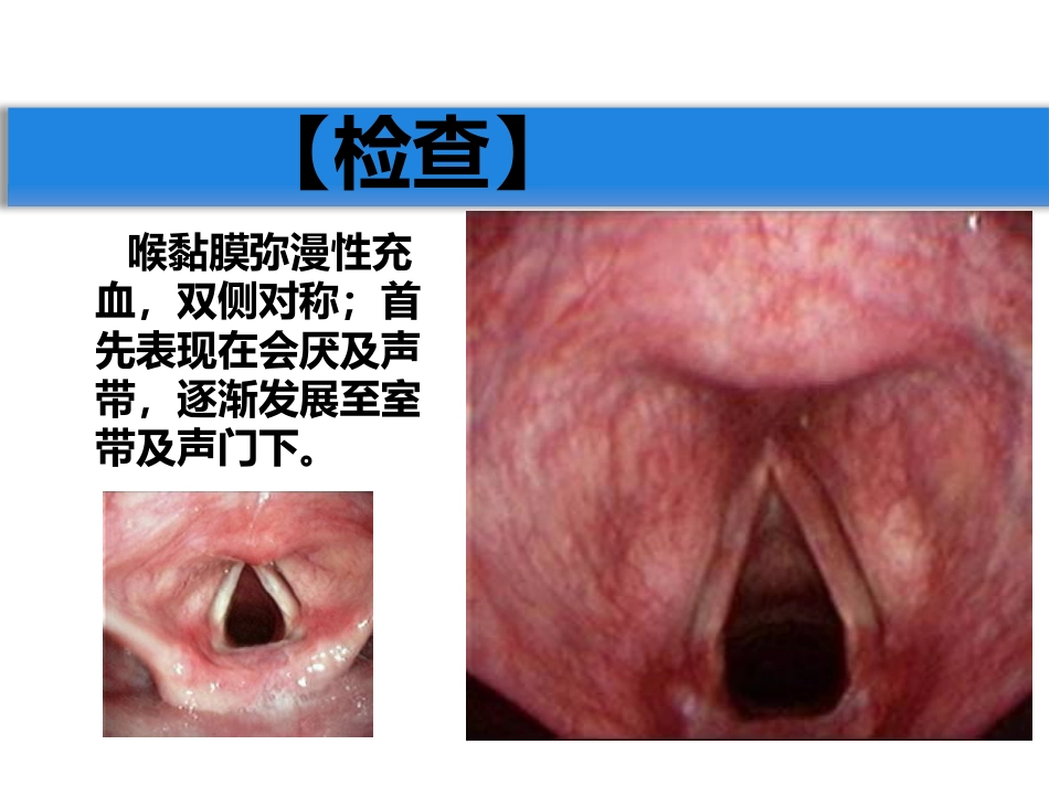 急慢性喉炎_第5页