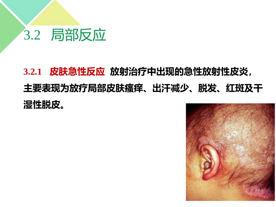 鼻咽癌的放疗护理_第12页