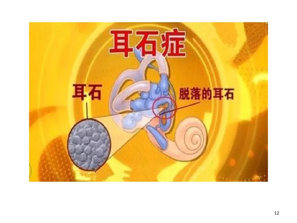 耳石症的诊治PPT_第12页