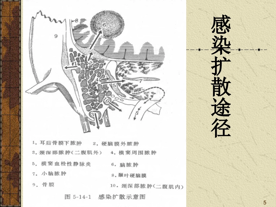 耳源性颅内外并发症ppt课件_第5页