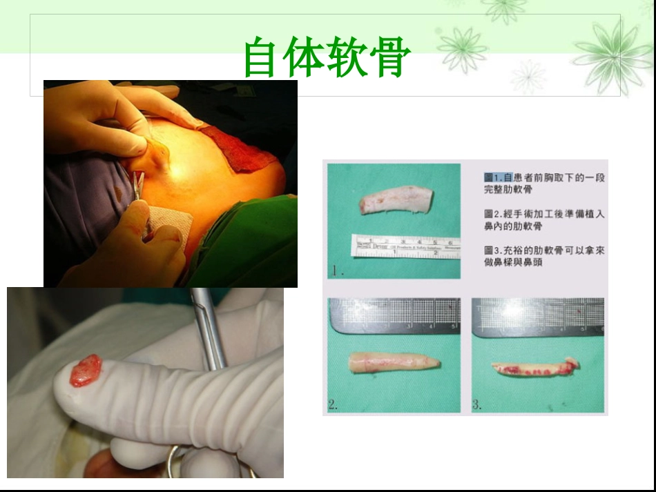鼻部整形隆鼻术ppt课件_第11页