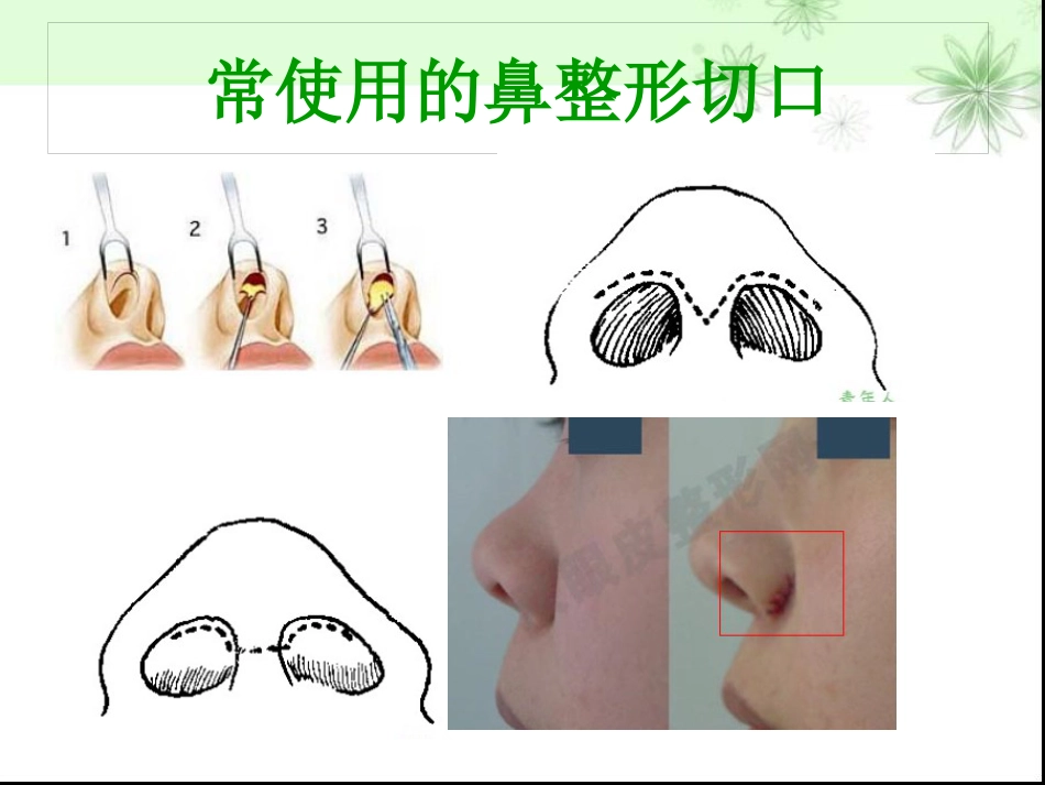 鼻部整形隆鼻术ppt课件_第12页