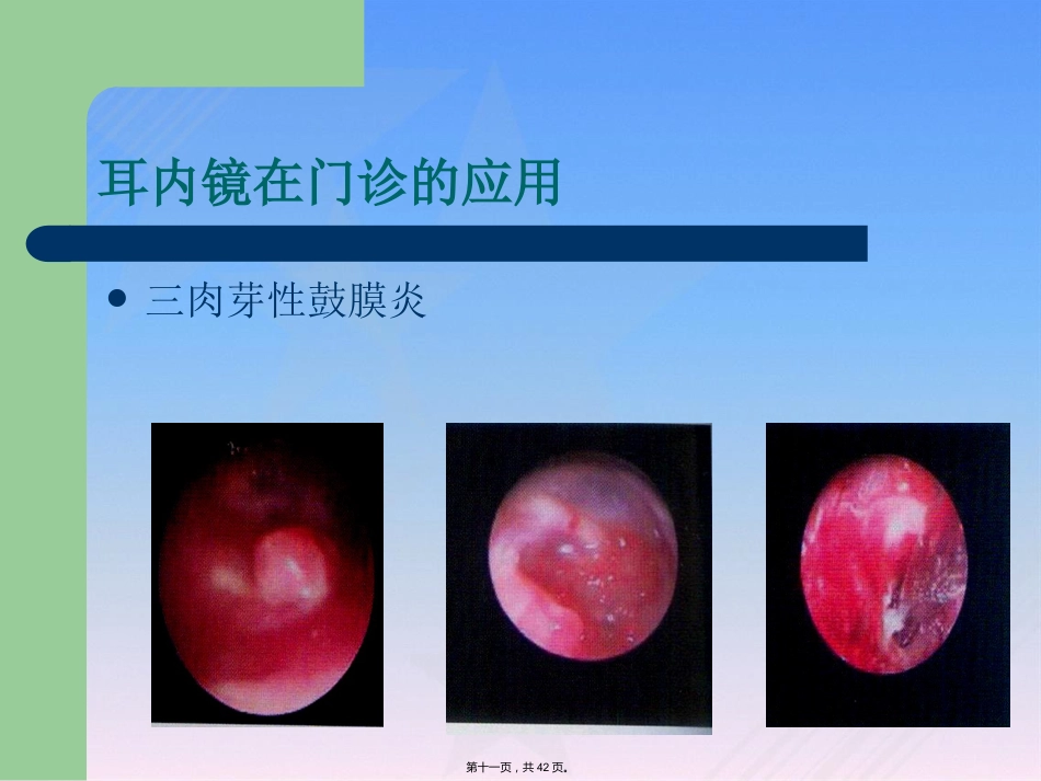 耳内镜临床应用_第11页