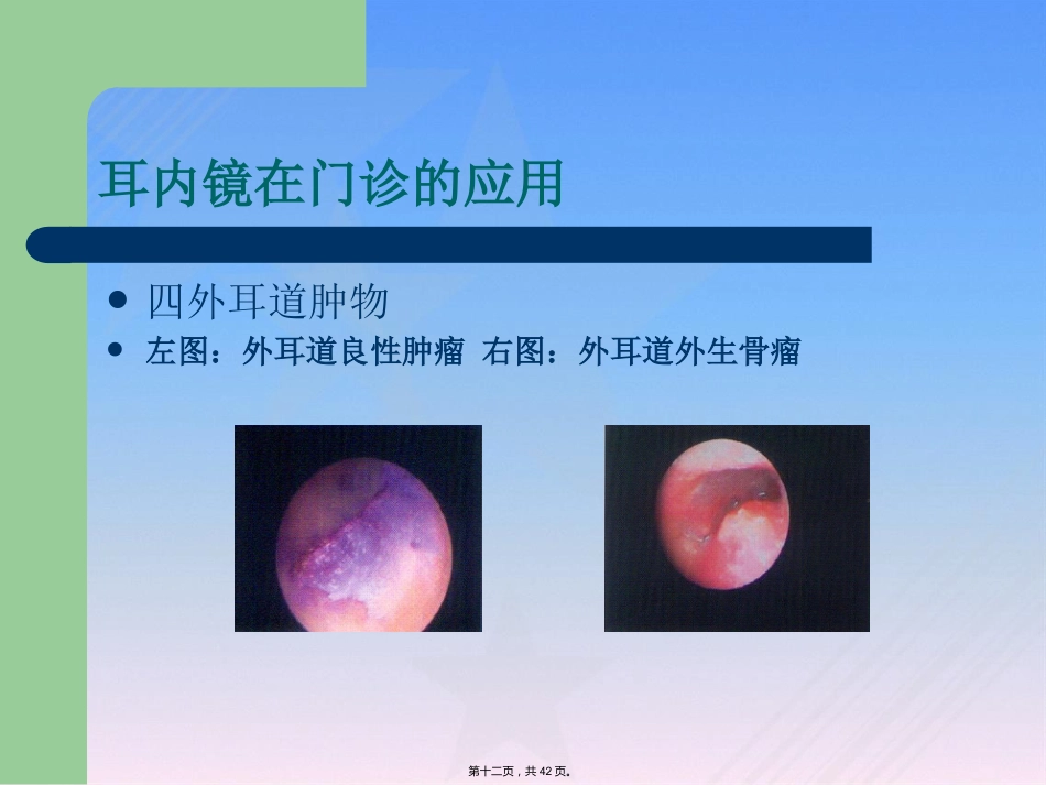 耳内镜临床应用_第12页