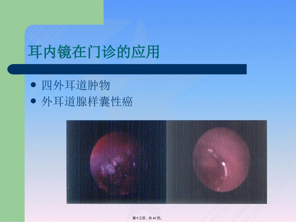 耳内镜临床应用_第13页