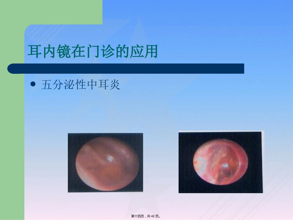 耳内镜临床应用_第14页