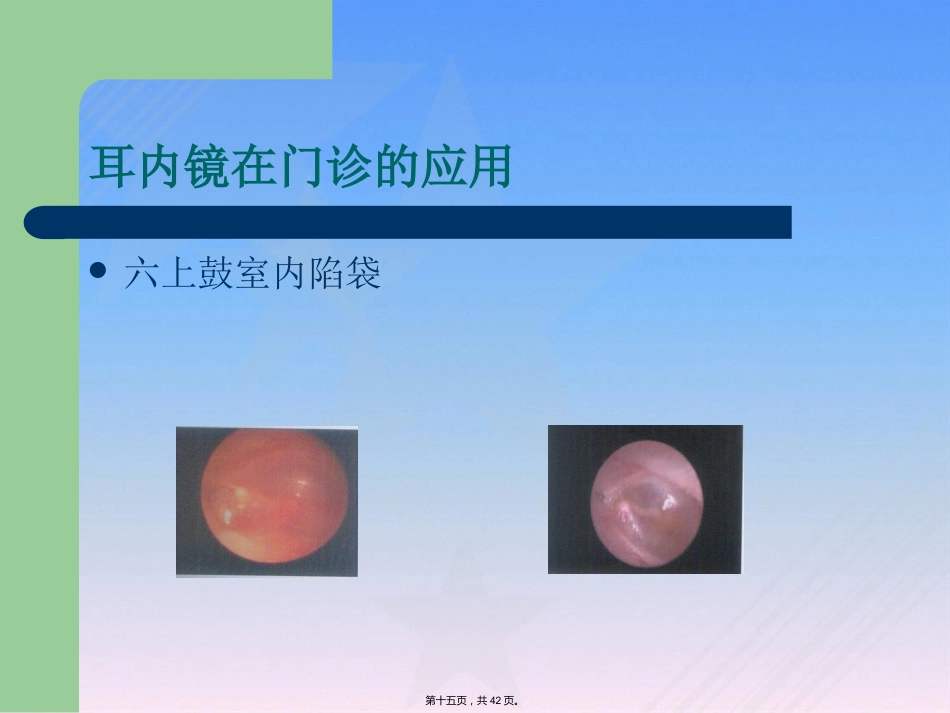 耳内镜临床应用_第15页