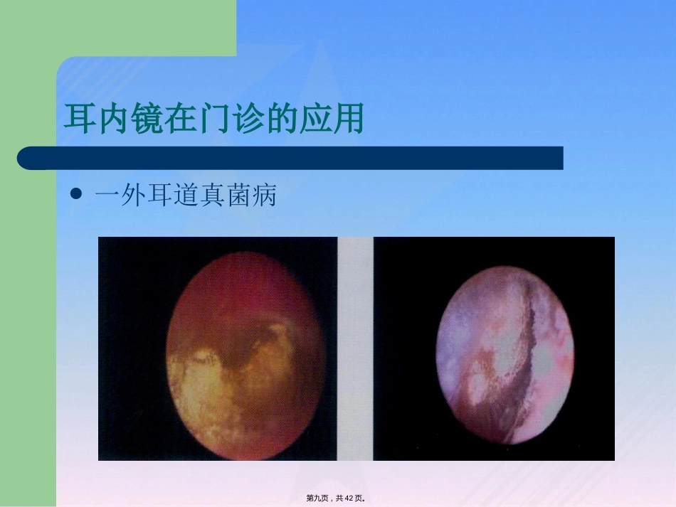 耳内镜临床应用_第9页