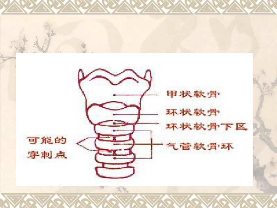 经口鼻气管插管改为经皮气管切开医护配合_第13页