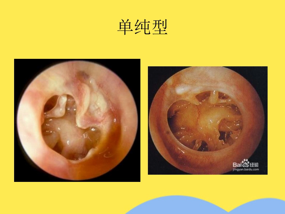 慢性中耳炎_第7页