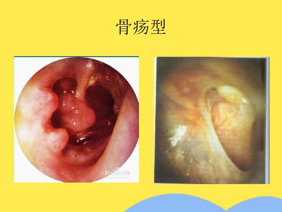 慢性中耳炎_第9页