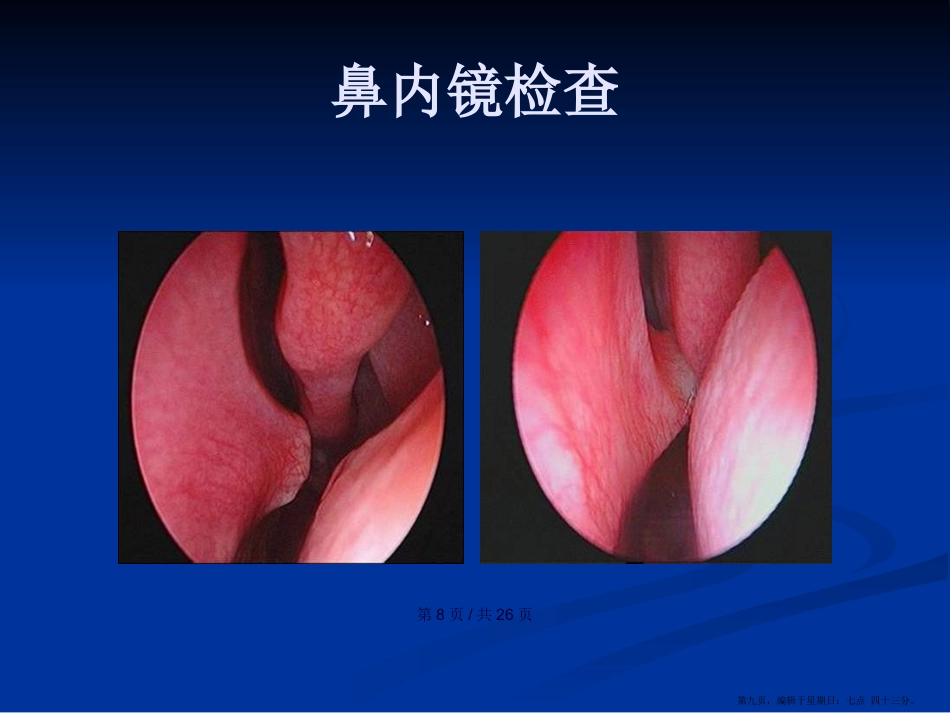 鼻中隔疾病学习教案_第9页