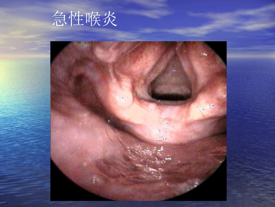 喉部疾病_第10页