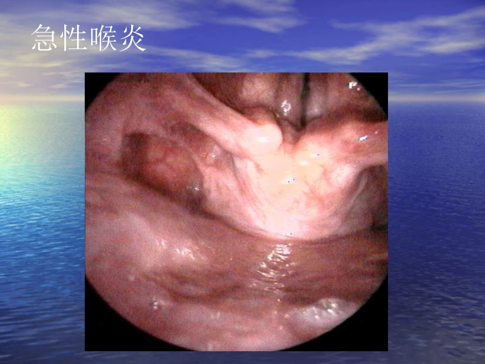 喉部疾病_第11页