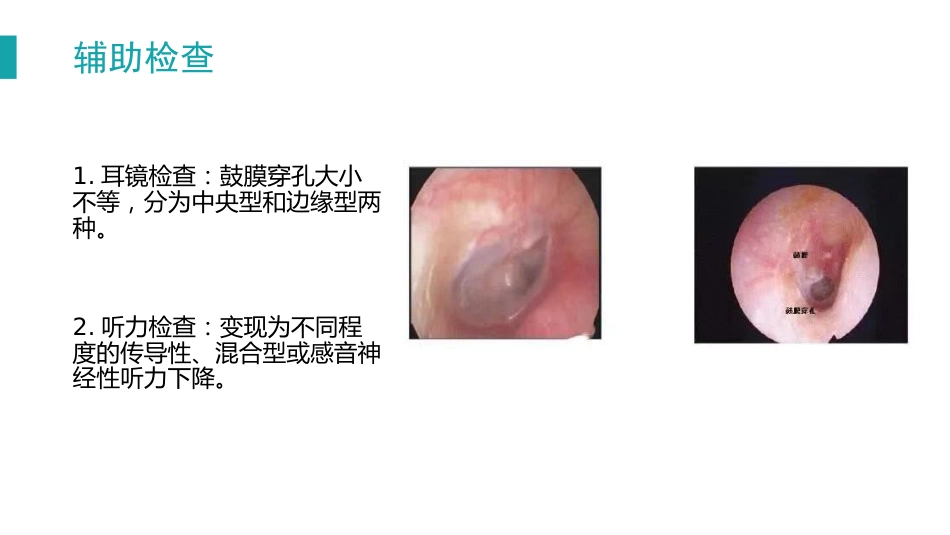 慢性化脓性中耳炎_第10页