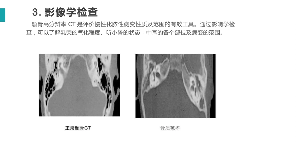 慢性化脓性中耳炎_第11页