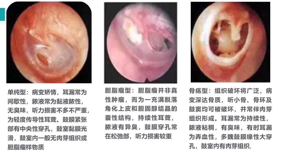 慢性化脓性中耳炎_第6页