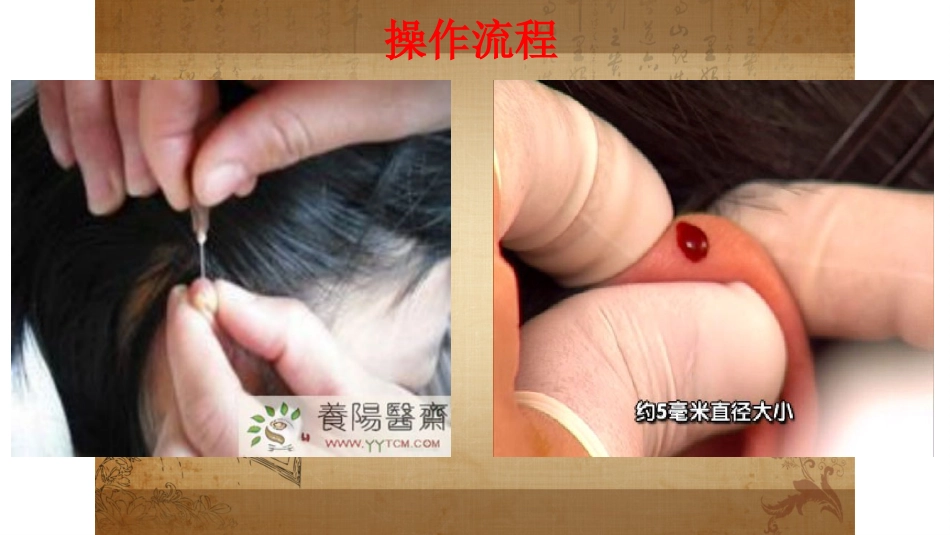 耳尖放血疗法_第10页