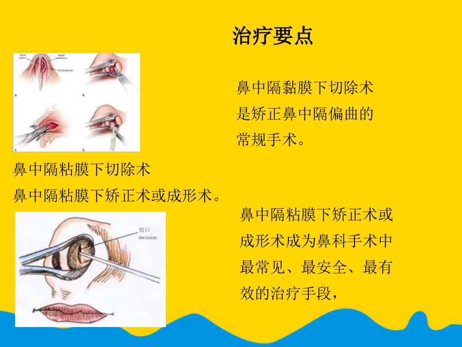 鼻中隔偏曲矫正术张影专选课件_第14页