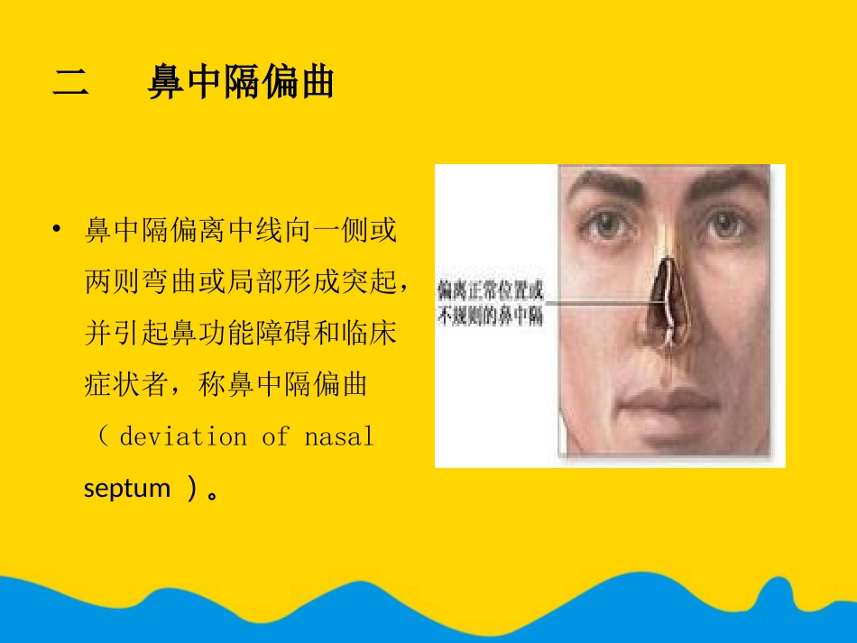 鼻中隔偏曲矫正术张影专选课件_第6页
