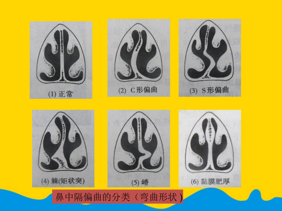鼻中隔偏曲矫正术张影专选课件_第7页